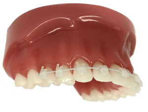 Zahnspange Muenchen - Clarity ultra Keramikbracket-System