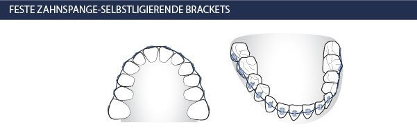 Feste Zahnspange mit selbstligierenden Brackets - Kieferorthopäden Münchner Freiheit 