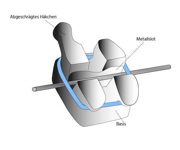 zahnspange_herkoemmliche_brackets.png 