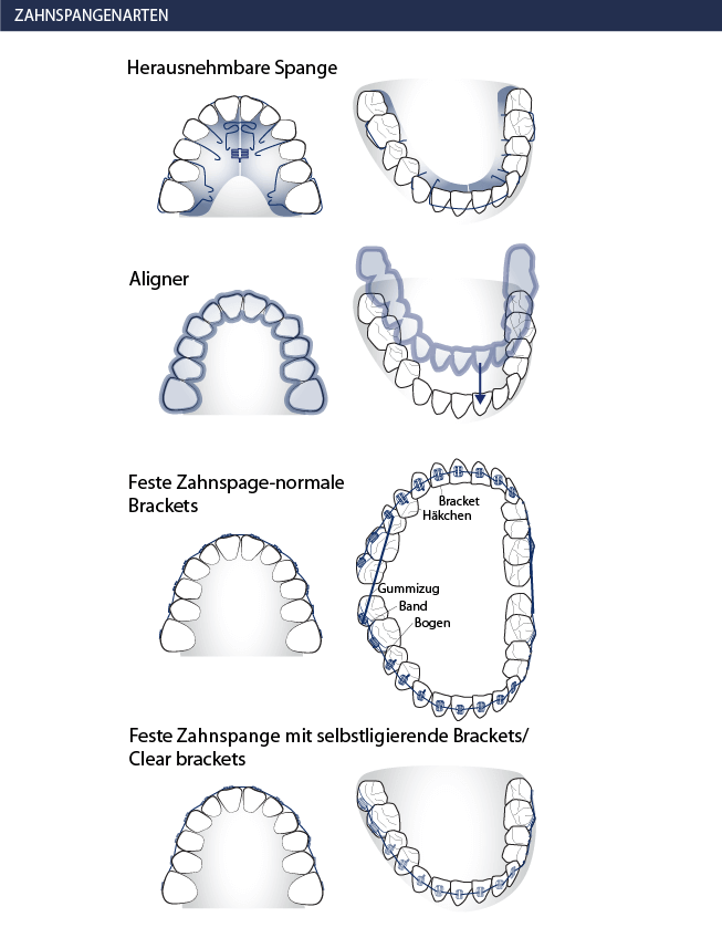 Verschiedene Zahnspangenarten - Kieferorthopäden Münchner Freiheit 