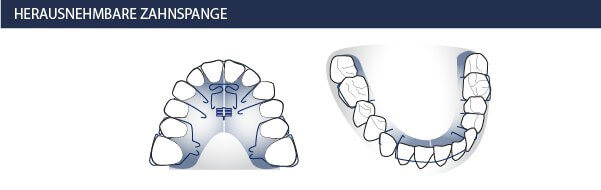 Herausnehmbare Zahnspange - Kieferorthopäden Münchner Freiheit 