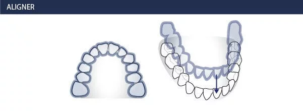 Invisalign, Unsichtbare Zahnspange - Kieferorthopäden Münchner Freiheit 