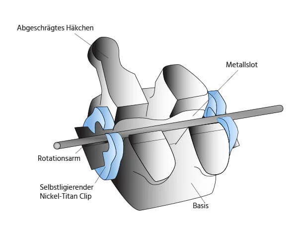 Zahnspange mit selbstligierenden Brackets - Kieferorthopäden Münchner Freiheit 