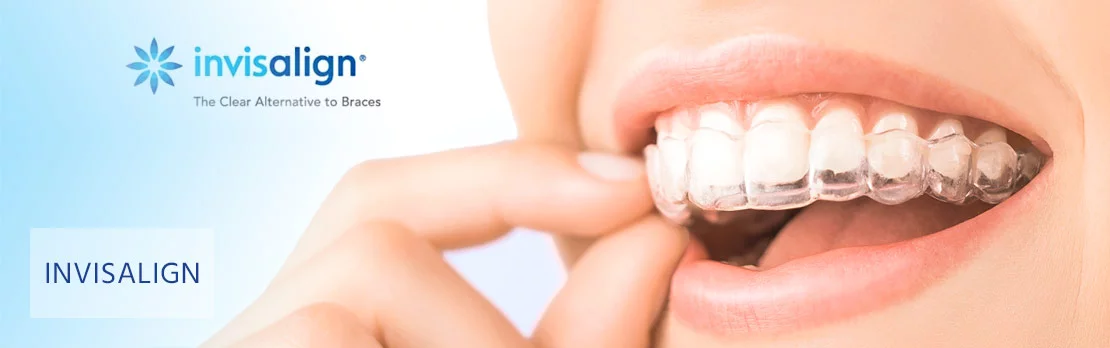 Invisalign für Erwachsene | Kieferorthopäden Münchner Freiheit